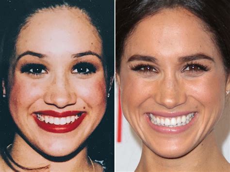 meghan markle nose job|Meghan Markles Nose Requested in Rhinoplasty Procedues